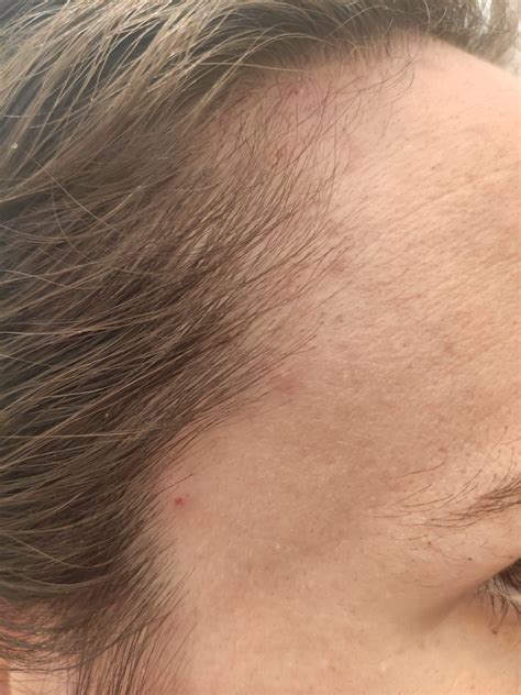 Dermatite o acne? - Dermatite seborroica - DermaClub Forum