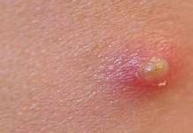 Herpes is caused by the herpes simplex virus. Scabies - Symptoms, Causes and other related complications