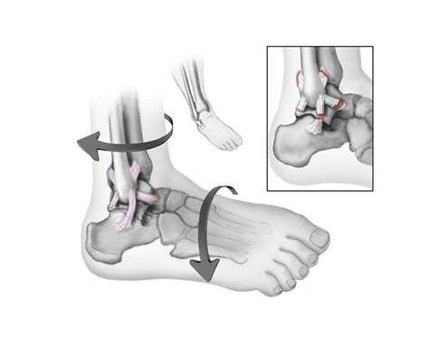 Unsurprisingly, a grade 3 mcl tear is the most severe. Sprained Ankle - OrthoInfo - AAOS