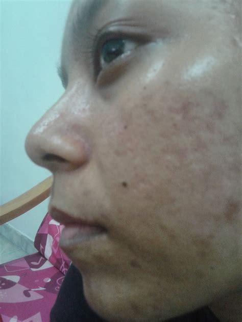 The unique formula simultaneously improves the appearance of existing acne scars, and prevents the formation of new scars. Daughter Theresa: Hiruscar Post Acne Gel Review (continue~)
