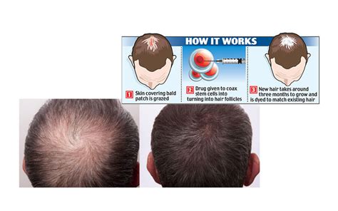 Some types of hair loss are permanent, like male and female pattern baldness. Stem Cells for Hair Loss: The Next Breakthrough ...