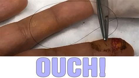 Finger Laceration Stitched up by Dr Gilmore - YouTube