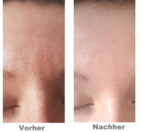 Auch wenn entzündungen eine natürliche abwehrreaktion sind, können die symptome die gesundheit beeinträchtigen. Mesoporation - La Vie Aesthetic