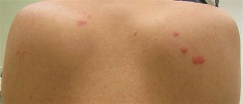 Come riconoscere punture? | Cimici dei letti Roma Zucchet