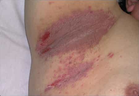 It is kind of fungal infection. Intertrigo - Symptoms, Causes, Diagnosis, Treatment ...