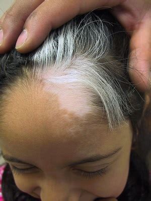 Is grey hair more common in certain people? Worried about white vitiligo hair? | The Vit Pro (A ...