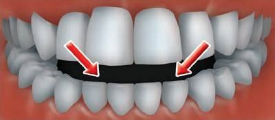 I received an email from a student, how can you verify which is which? Abfraction Vs Gum Recession - The Engineering Internship ...