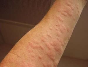 They may also burn or sting. Remedy for Hives