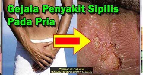 Maybe you would like to learn more about one of these? Contoh Sipilis Pada Pria - Contoh Gejala Sifilis Pada Pria ...