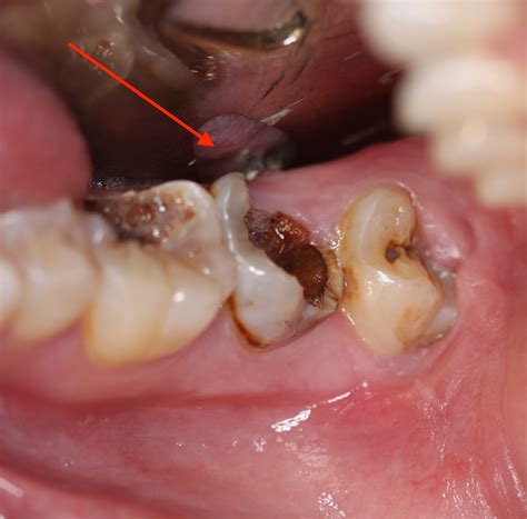 What are signs and symptoms of an infected wisdom tooth? Your wisdom tooth hurts. What now?