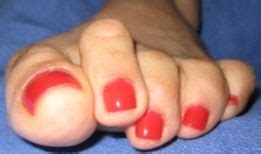 In the early stages of toenail fungus, it's not that hard to trim the nails. When is a hammertoe not just a hammertoe? | Hammer toe ...