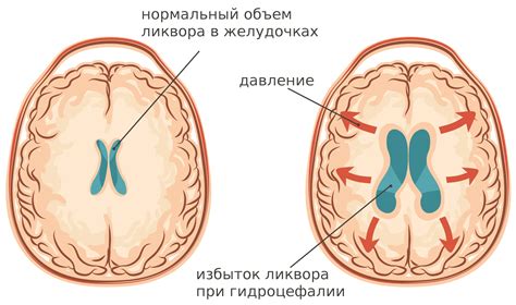 У ребенка с синдромом аспергера могут быть следующие признаки. Гидроцефальный синдром (ГГС) у детей и взрослых