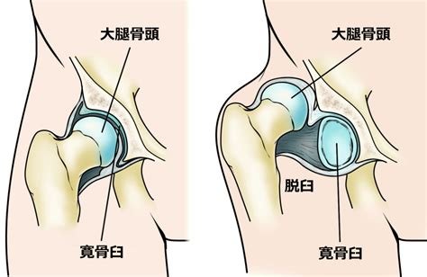 Lumbrical tendon passes volar to transverse metacarpal ligament. 変形性股関節症を診る｜西宮・宝塚の整体は西宮甲東園整体院HAL