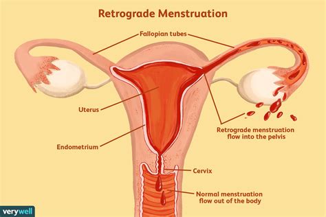 Endometriosis can affect women of any age. Endometriosis معنى : Ø§Ù„Ø§Ù†ØªØ¨Ø§Ø° Ø§Ù„Ø¨Ø·Ø§Ù†ÙŠ Ø§Ù„Ø ...