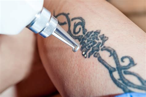 How do tattoo experts ensure this? Can Tattoos Be Removed Completely? - Tattoo Removal Sydney ...