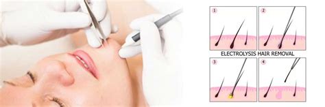 This is a method of hair removal in which a laser (a concentrated beam of light) is used to remove unwanted hair. Electrolysis Philadelphia | Treatment for Hair Removal ...