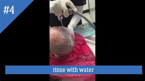 Keep in mind that natural hair tends to be drier than other types, so if you have dyed your natural hair, it may be best to only wash it once a week. How to wash hair after 7 days of hair transplant - YouTube