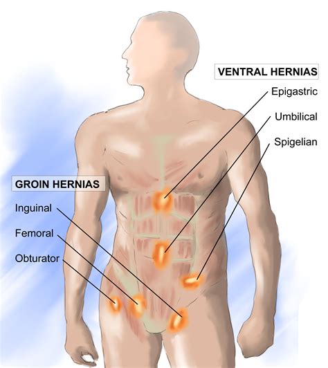 Maybe you would like to learn more about one of these? Hernia Consultation Adelaide