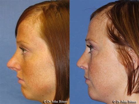 Your nose job may be covered by your insurance if your procedure is enhancing the function of your nose (ex: Rhinoplasty Layton, UT | Salt Lake City | Bitner Facial Plastic Surgery