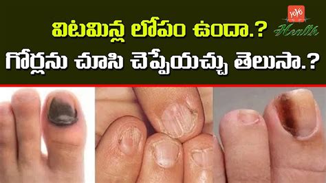 Vitamin d deficiency can cause symptoms of fatigue and bone pain that can lead to health risks including osteoporosis and depression. విటమిన్ల లోపమా? గోర్లను చూసి చెప్పేయచ్చు | Vitamin ...