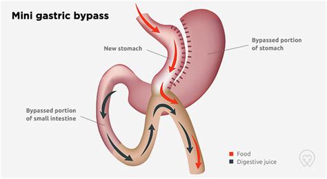 It could also contain a detailed dietary plan. Gastric Bypass Weight Loss Surgery: cost UK, diet, side ...