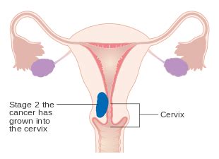 Uterine cancer usually happens after menopause. Uterine cancer before menopause. Extinderea venelor ...