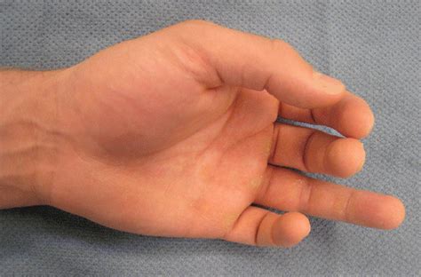 A zone i flexor tendon injury. Hand | Plastic Surgery Key