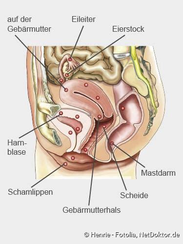 Endometriosis is a condition where tissue similar to the lining of the womb starts to grow in other places, such as the ovaries and fallopian tubes. Endometriose: Beschreibung, Symptome, Folgen, Behandlung ...