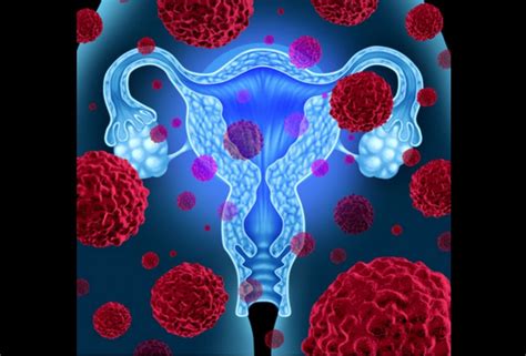 Since the peritoneum and ovaries arise from the same tissues during embryonic development, it's possible that cancer could result from the cells of the peritoneum. Actor Nafisa Ali Diagnosed with Ovarian Cancer. What Is It?