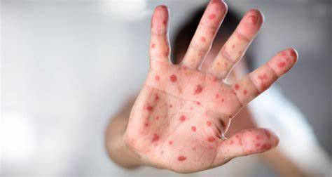 ЭНТЕРОВИРУСНАЯ ИНФЕКЦИЯ (ЭВИ) Картинка - ЭНТЕРОВИРУСНАЯ ИНФЕКЦИЯ (ЭВИ)