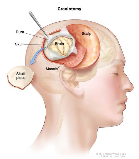 Which children are at risk for a brain tumor? What is Brain Tumor, Causes and Symptoms ? —Health Save Blog