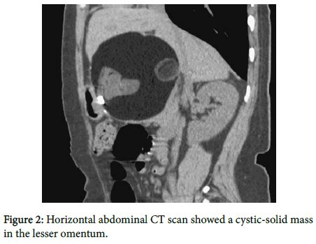 This is an online quiz called lesser omentum. Mature Teratomas of the Lesser Omentum | SciTechnol