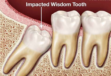 Well, wisdom tooth extraction without insurance is about $100 to $650 per tooth, depending on case and nature. Pin on Best Torrance Dentist