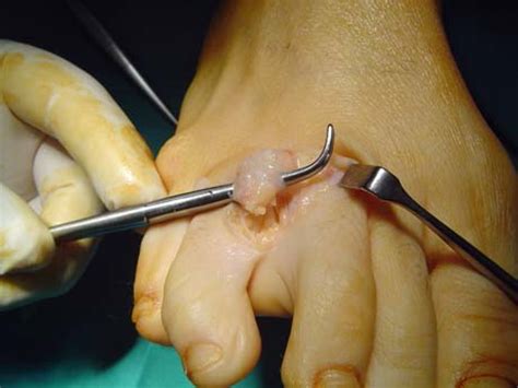 Morton neuromas are more conspicuous when the patient is prone positioned. MORTON'S NEUROMA | GEORGE D. GOUDELIS MD. Ph.D.