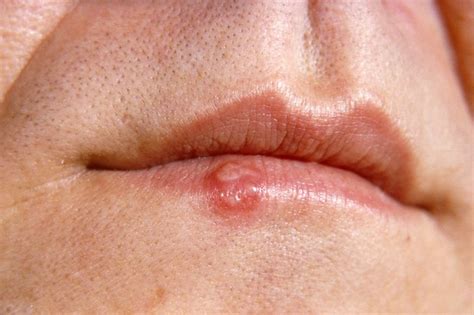 Babies can catch the cold sore virus through contact with a cold sore on another person. Cold sores - NHS.UK