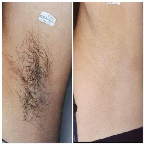 Best of all, this is a permanent procedure, so you before your laser hair removal session, there are certain forbidden activities and safety guidelines to keep in mind. Before and after of underarms. This is great results from ...