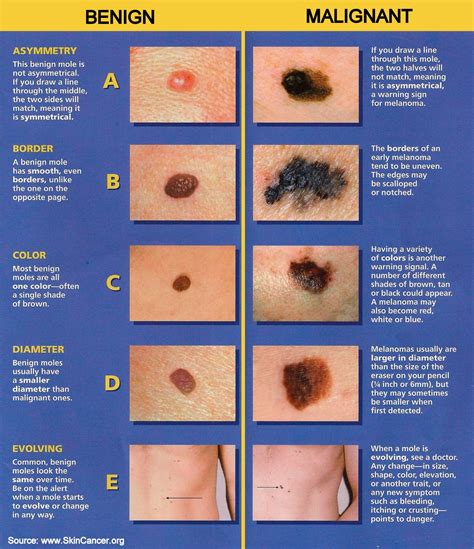 The nail begins to separate from the nail bed and the. The ABCDE Rule of Skin Cancer - Quality Dermatology