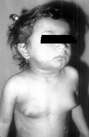 Mccune albright syndrome is characterized by the triad of polyostotic fibrous dysplasia, pigmentary skin lesions and endocrinopathy. SINDROME DE MCCUNE ALBRIGHT PDF