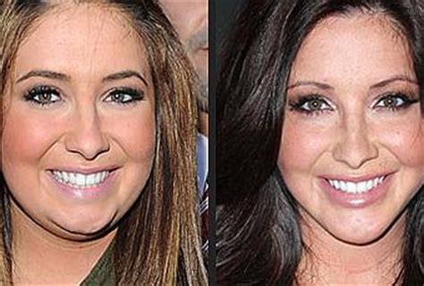 The procedure is generally performed by an oral surgeon to correct a variety of skeletal irregularities. Bristol Palin Before and After Surgery - Paperblog