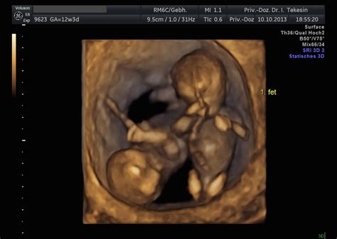 Da die feindiagnostik während des regulären zweiten ultraschalls durchgeführt wird, soll sie durch den behandelnden frauenarzt in seiner praxis durchgeführt werden. Warum Pränataldiagnostik - Dr. Tekesin