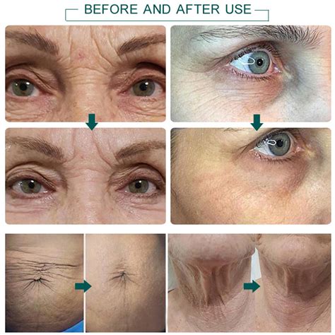 If you are bothered as to if electrolysis is a cheap method, yes. beauty jett micro plasma laser eye lift pen needles ...