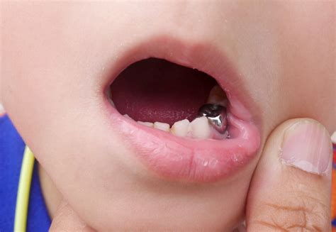 Dental amalgam is a liquid mercury and metal alloy mixture used in dentistry to fill cavities caused by tooth decay. Dental amalgam (silver fillings) - what you need to know ...