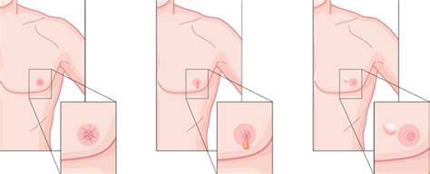 Mouth cancer symptoms in hindi. What about breast cancer in men? | The Daily Courier ...