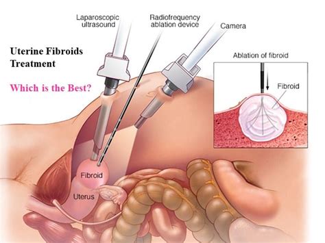 For some women fibroids cause no symptoms, but when they do, doctors say problems often involve heavy. Best Gynecologist in Hyderabad | Dr. T Rajeshwari Reddy