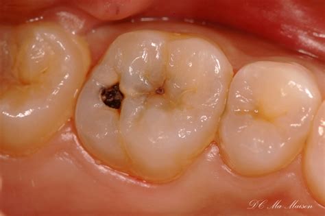 More meanings for 虫歯 (mushiba). 虫歯の痛み ( その他の病気 ) - pinchanのブログ - Yahoo!ブログ