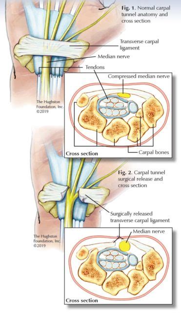 Learn about carpal tunnel syndrome symptoms and treatment. Carpal Tunnel Syndrome - Georgia