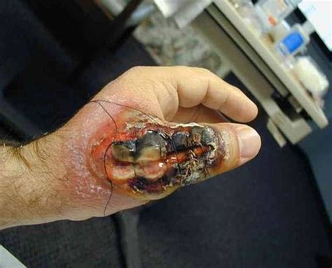 The hobo bite resembles the brown recluse bite, with a central blister that scabs and ulcerates, surrounded by a ring of swollen discoloration. ANTI-MULLAH: BROWN RECLUSE SPIDER - THE MOST DANGEROUS IN USA