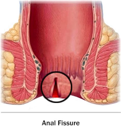After that, anything can happen. Anal Fissure Surgery : What are the symptoms, causes and ...