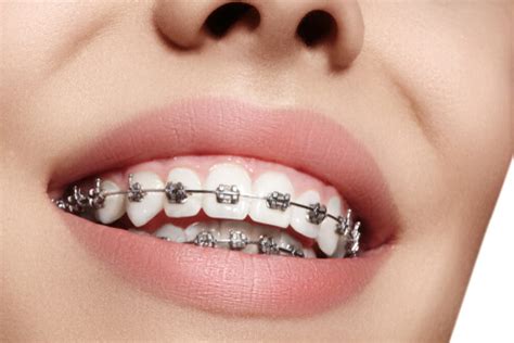 My friend is 29 and she's had hers on for 3 years whereas i had a retainer when i was 11 for less than 12 months. Teeth Straightening: How Long Do You Have To Wear Braces?