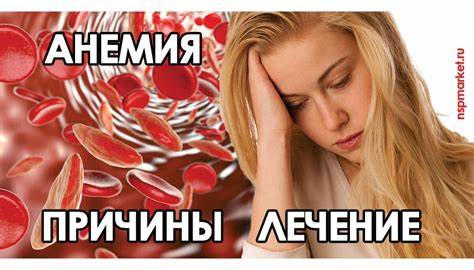 Анемия лечение диетой Железодефицитная анемия, анемия у детей, симптомы и лечение анемии Железодефицитная анемия, анемия у детей, симптомы и лечение анемии Анемия лечение диетой